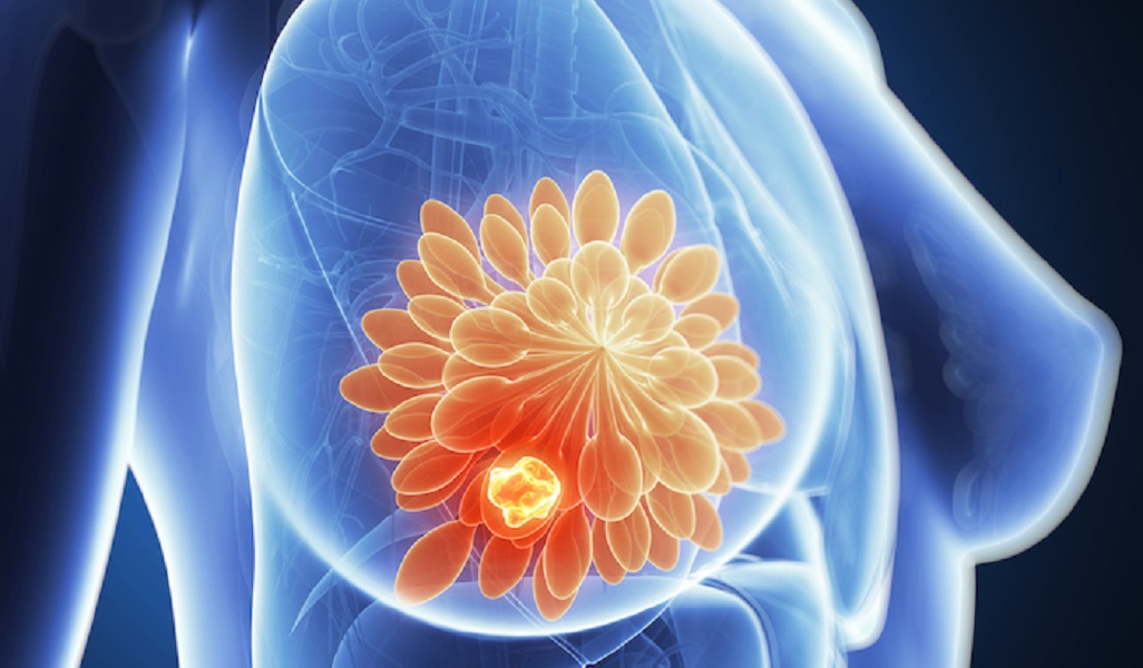 different-types-of-breast-cancer-in-women-explained